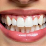 Licówki stomatologiczne: Na ile zębów je zakładać?